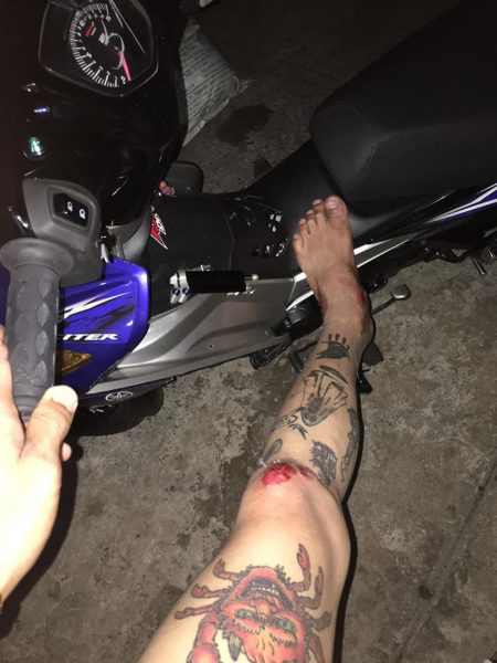 Hơn 300 bức ảnh nam nữ ngã xe máy trầy xước chân, ngã xe máy dập chân