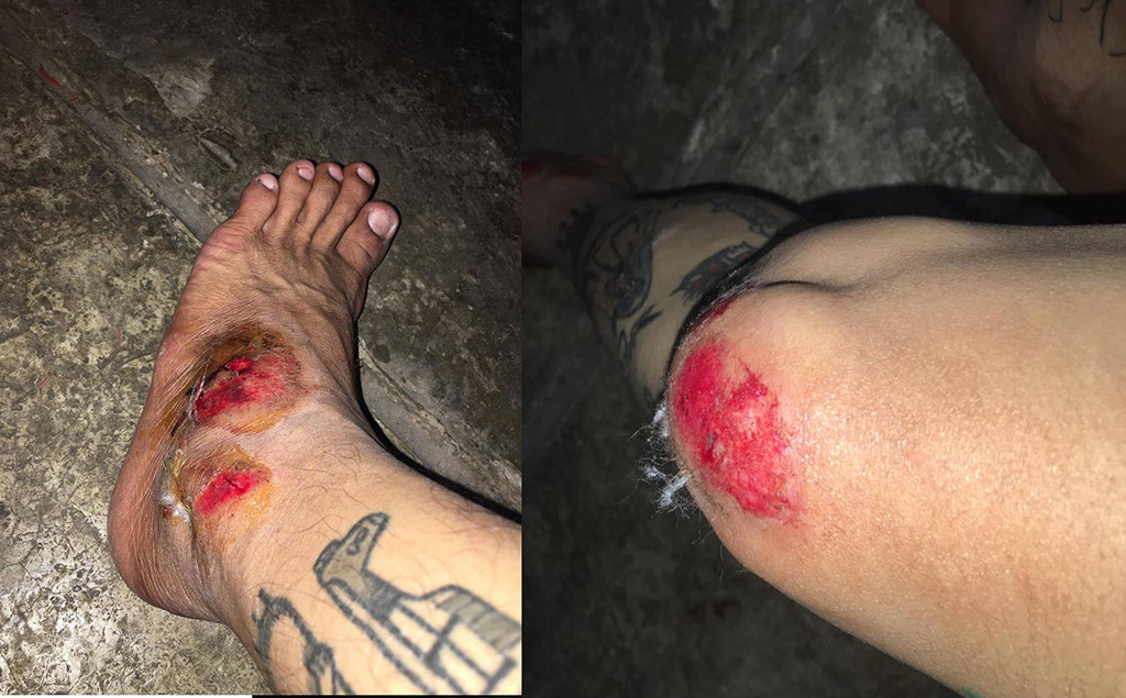 Hơn 300 bức ảnh nam nữ ngã xe máy trầy xước chân, ngã xe máy dập chân