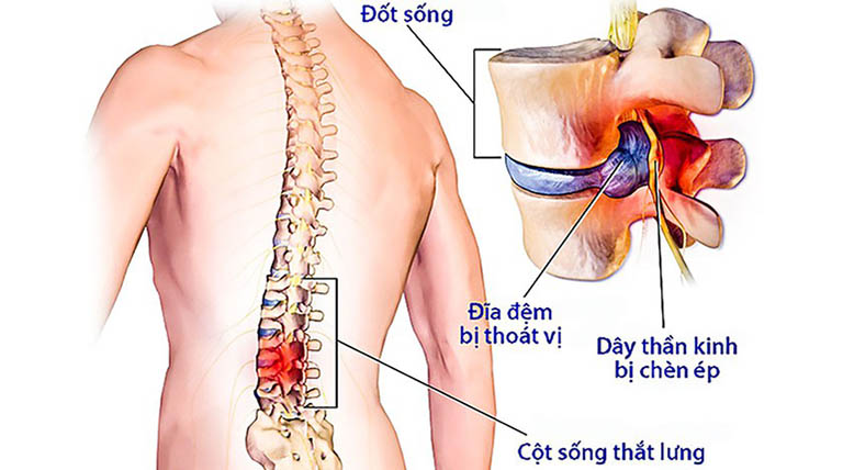 Cách phòng tránh chấn thương cho cầu thủ bóng đá - Bóng đá